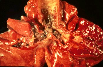 Oslerus - noduli alla trachea